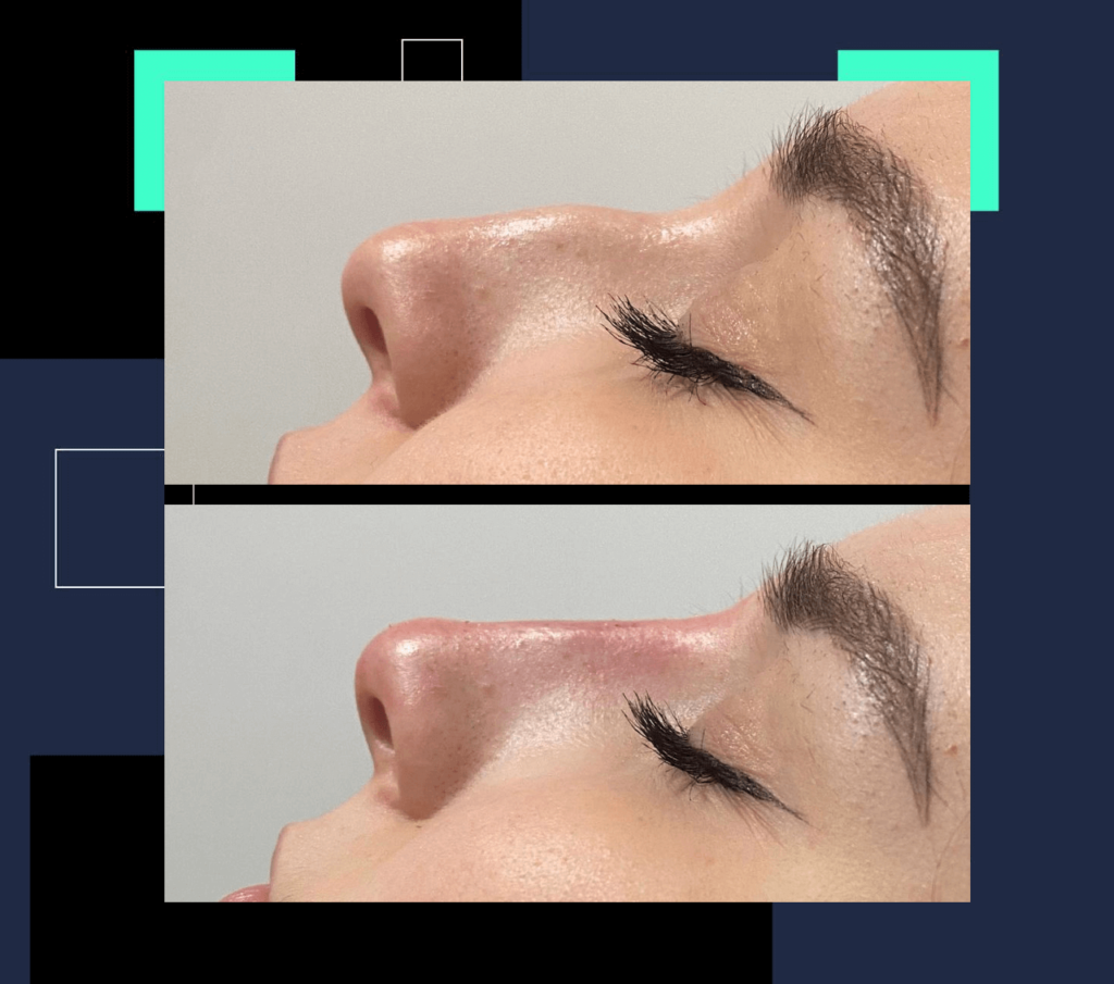 bodrum nose filler, bodrum burun dolgusu, burun estetiği