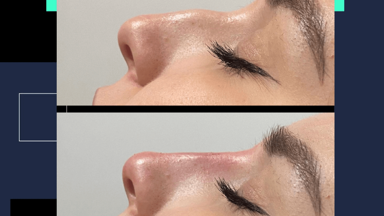 bodrum nose filler, bodrum burun dolgusu, burun estetiği