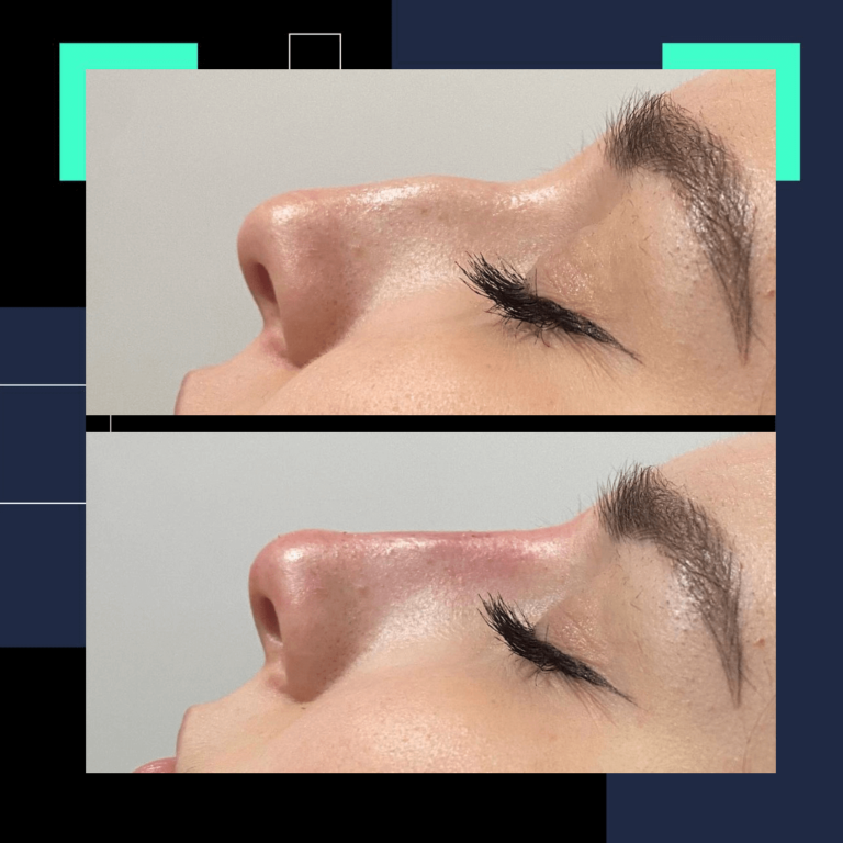 bodrum nose filler, bodrum burun dolgusu, burun estetiği