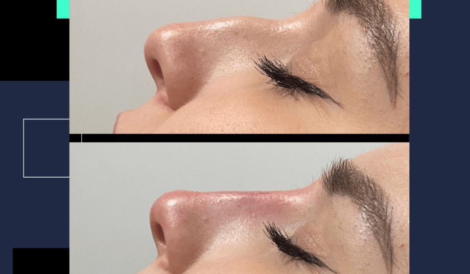 bodrum nose filler, bodrum burun dolgusu, burun estetiği