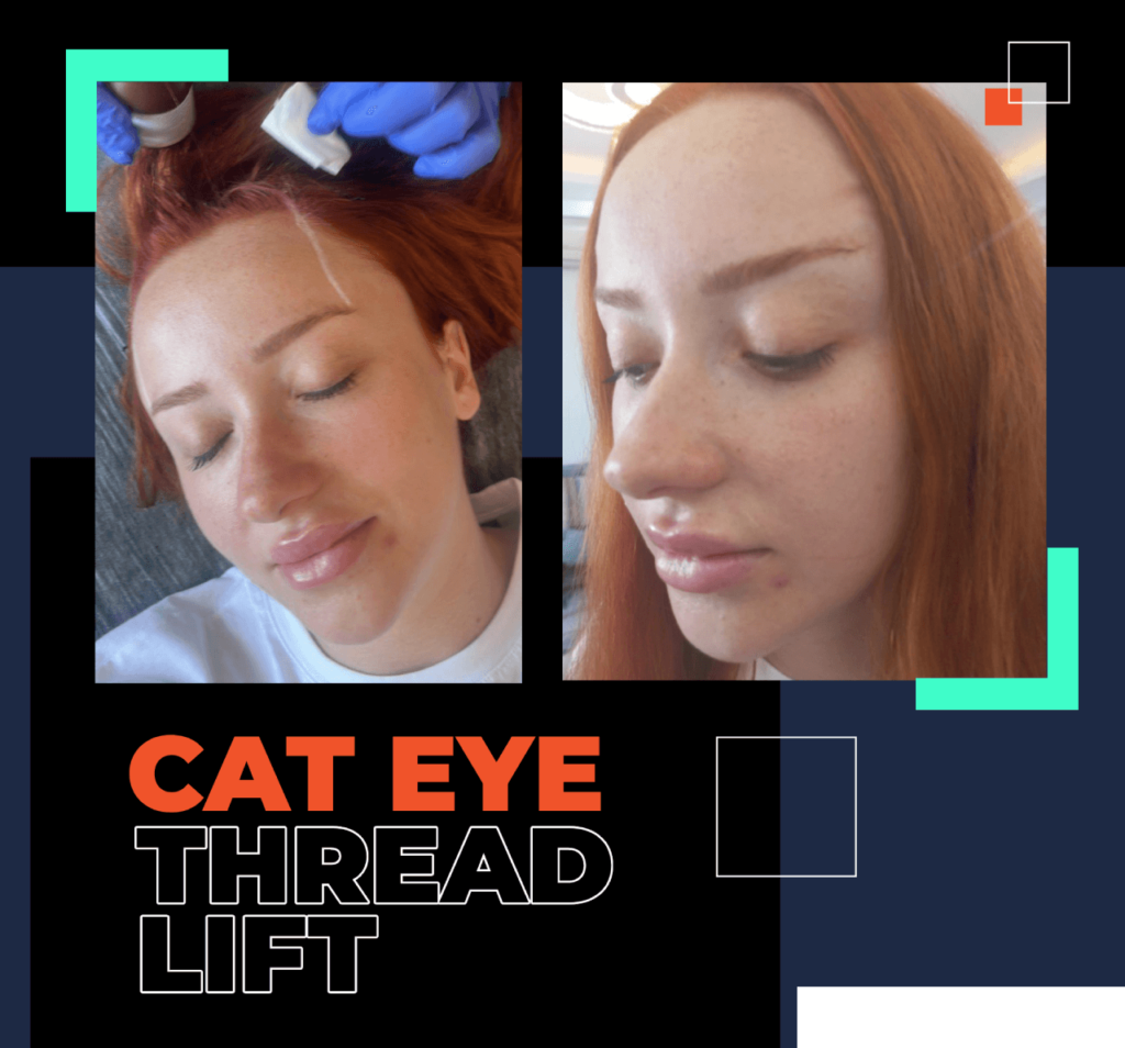 bodrum cat eye thread lift, kaş kaldırma