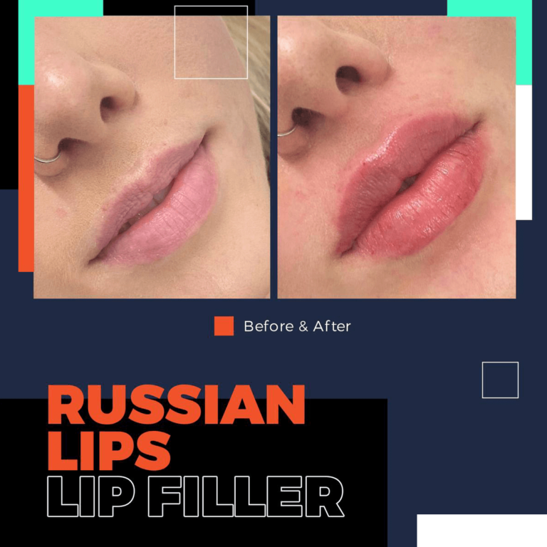 bodrum russian lip techniques, rus dudağı