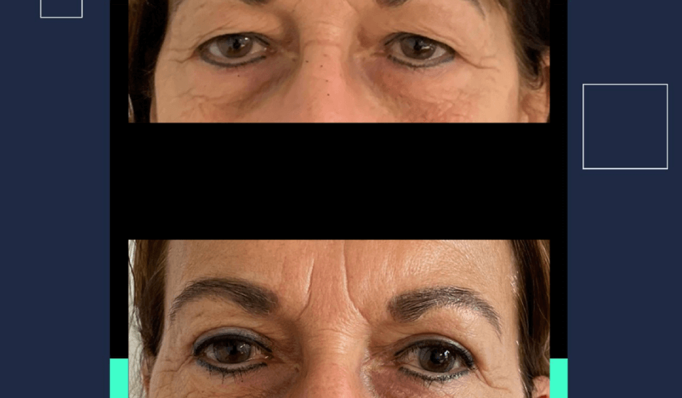 bodrum upper eyelid surgery