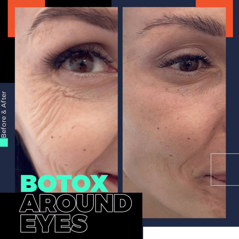 Bodrum botox price, botox discount