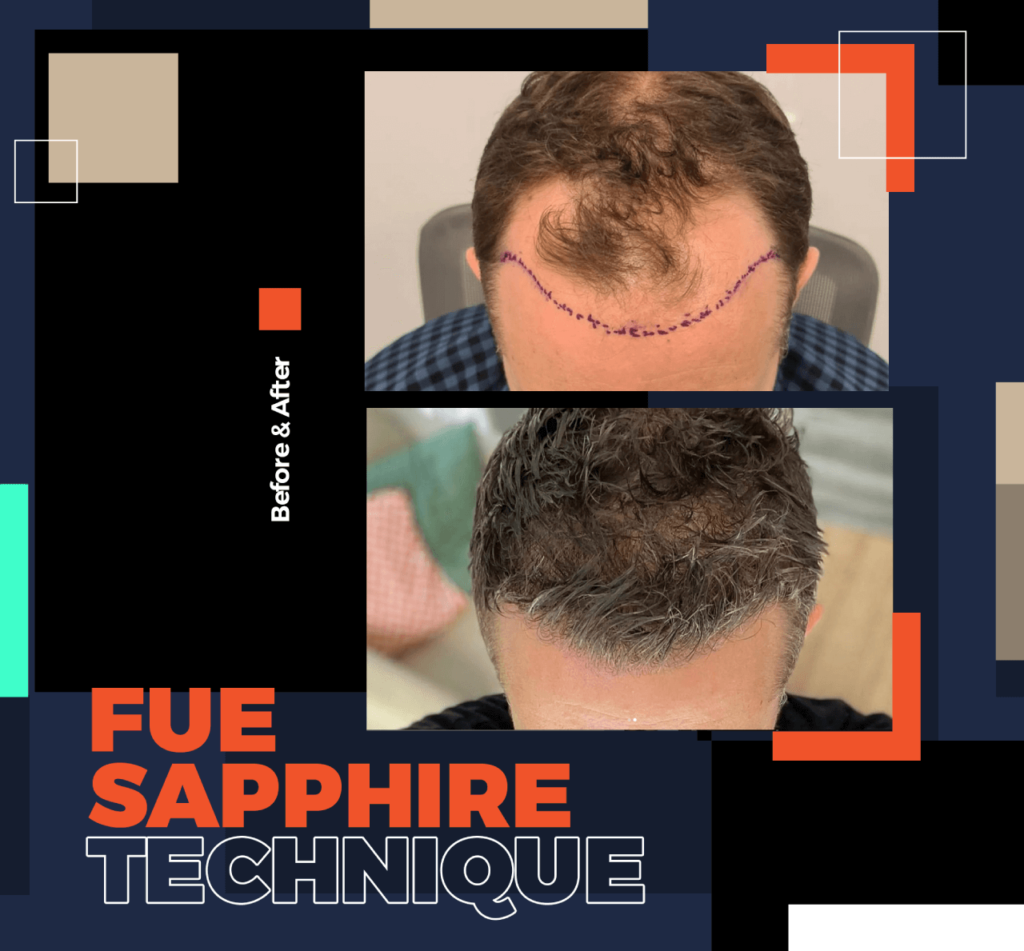 bodrum fue dhi hair transplant