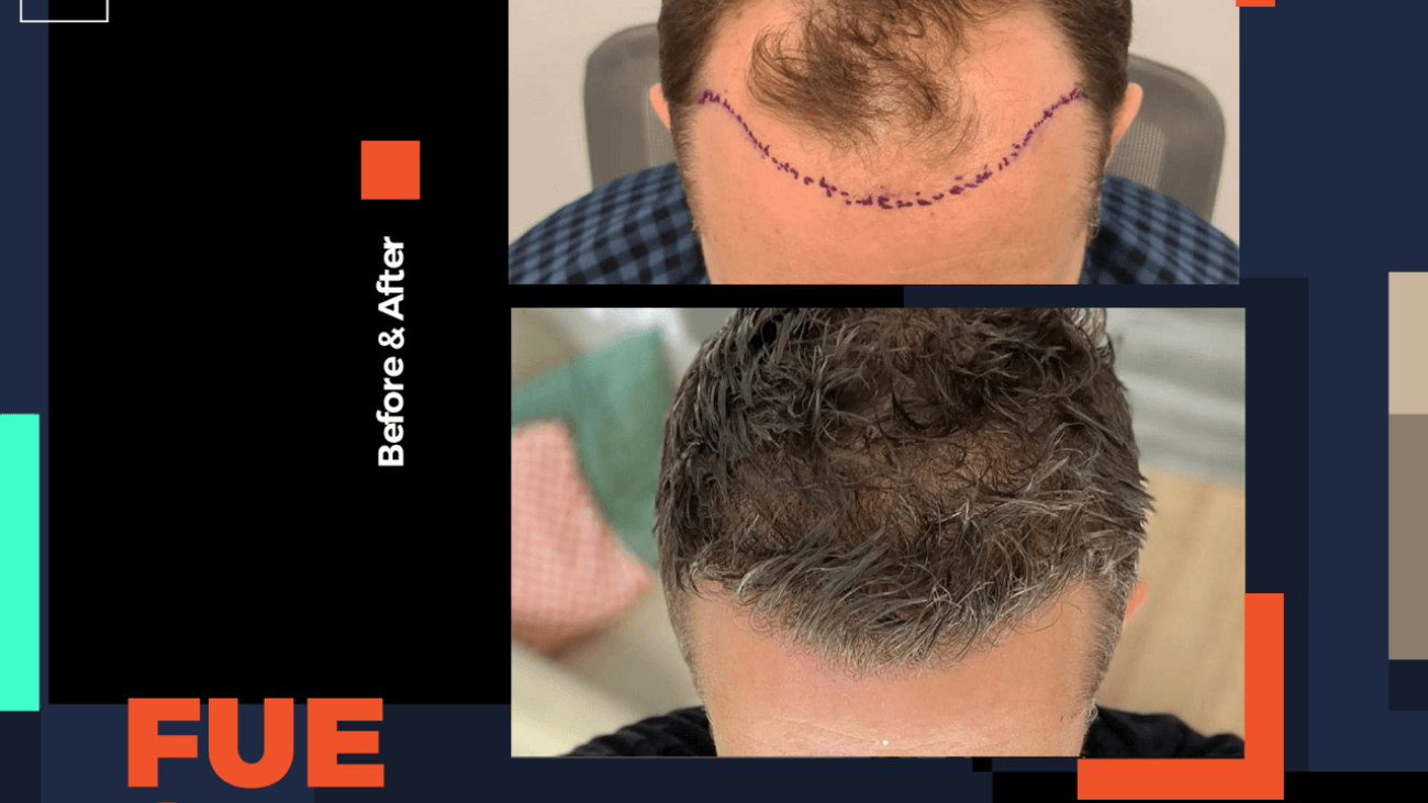 bodrum fue dhi hair transplant