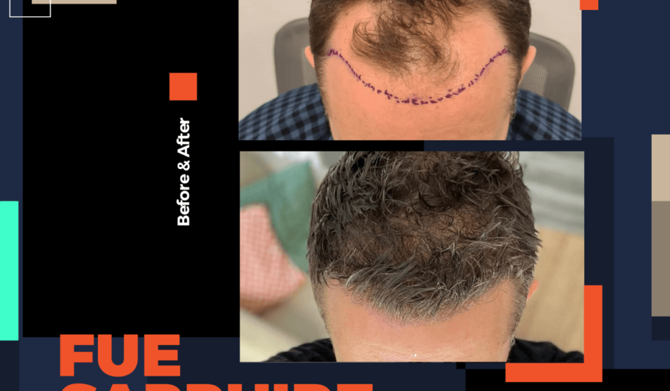 bodrum fue dhi hair transplant