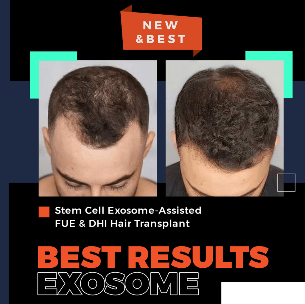 new hair transplant technique with exosome