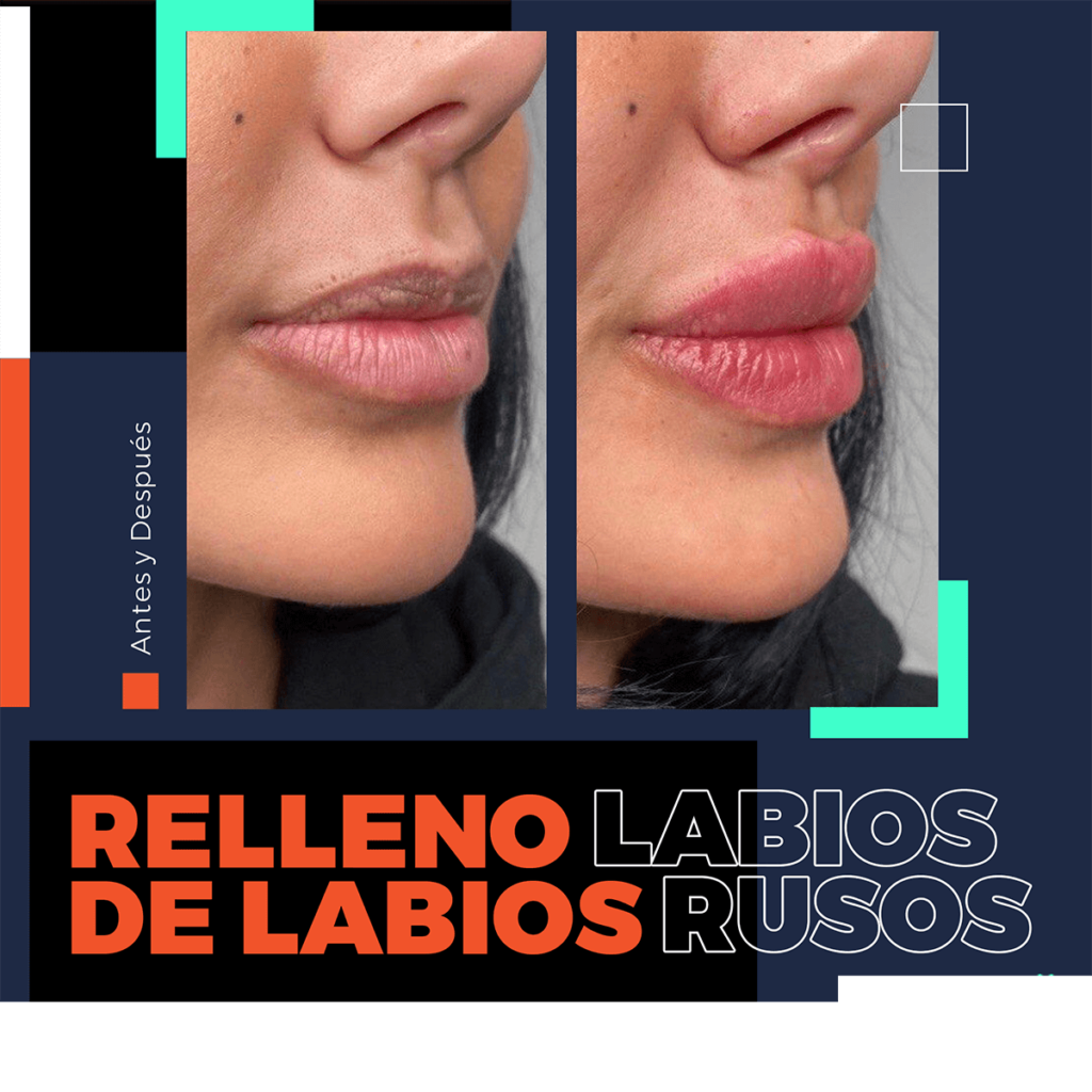 relleno de labios bodrum turquia