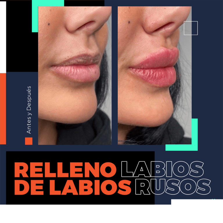 relleno de labios bodrum turquia