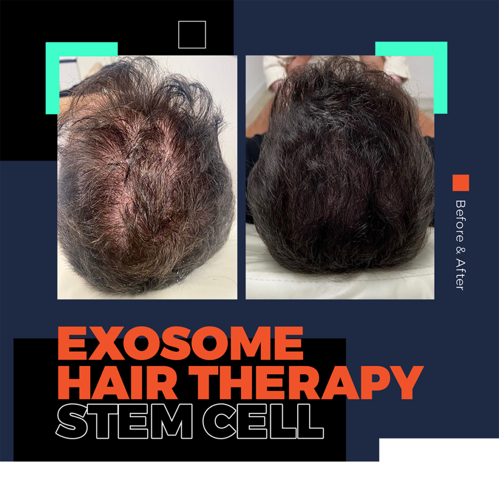 stemcell exosome hair loss therapy bodrum turkey