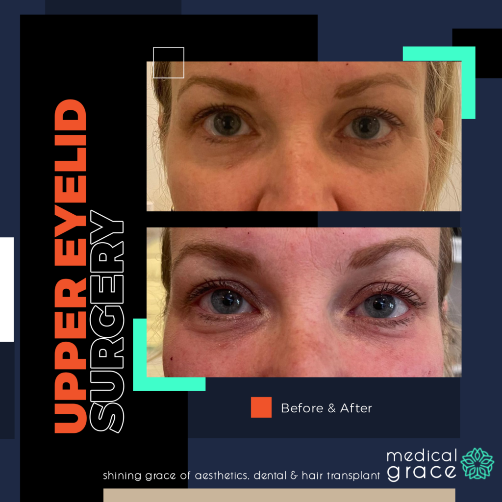 eyelid surgery bodrum