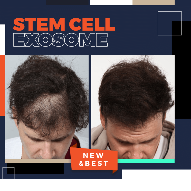 stemcell exosome hair loss therapy bodrum turkey